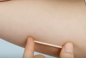 São Domingos passa a oferecer Implanon pelo SUS para mulheres